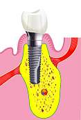 mit Implantataufbau verbundene Zahnkrone